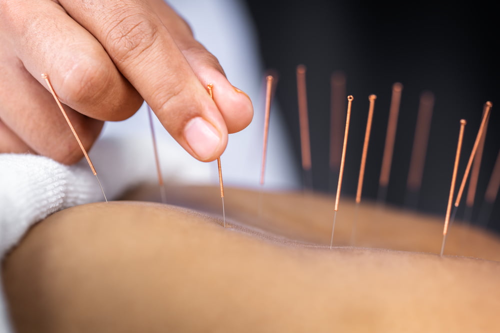 How Acupuncture Works For Pain